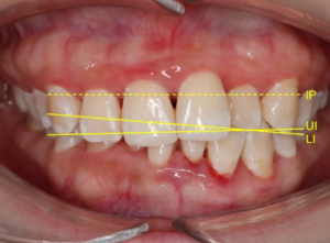 Why Some Bite Corrections Require Changes To Both Dental Arches