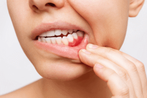 Why Some Patients Develop Tartar Quickly Despite Good Home Oral Care
